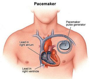 pace natural-pacemaker-10144-1-orig